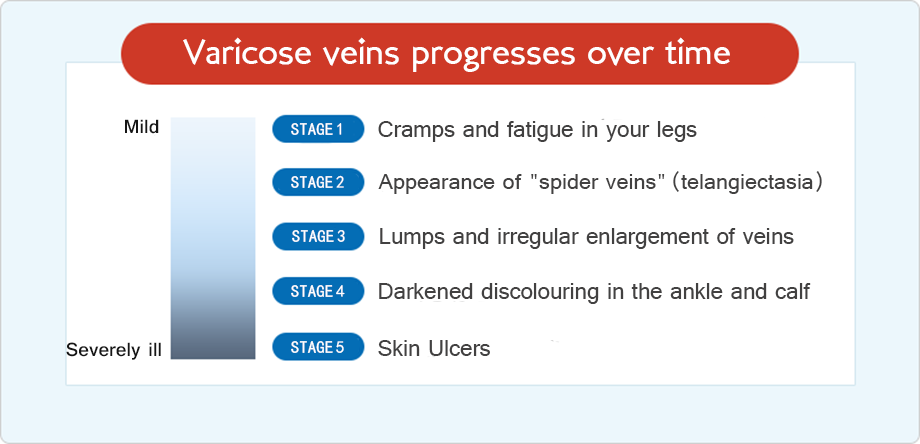 Varicose veins frequently progress and worsen over time
